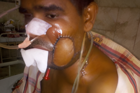 Oral Cancer-Picsart-AiImageEnhancer